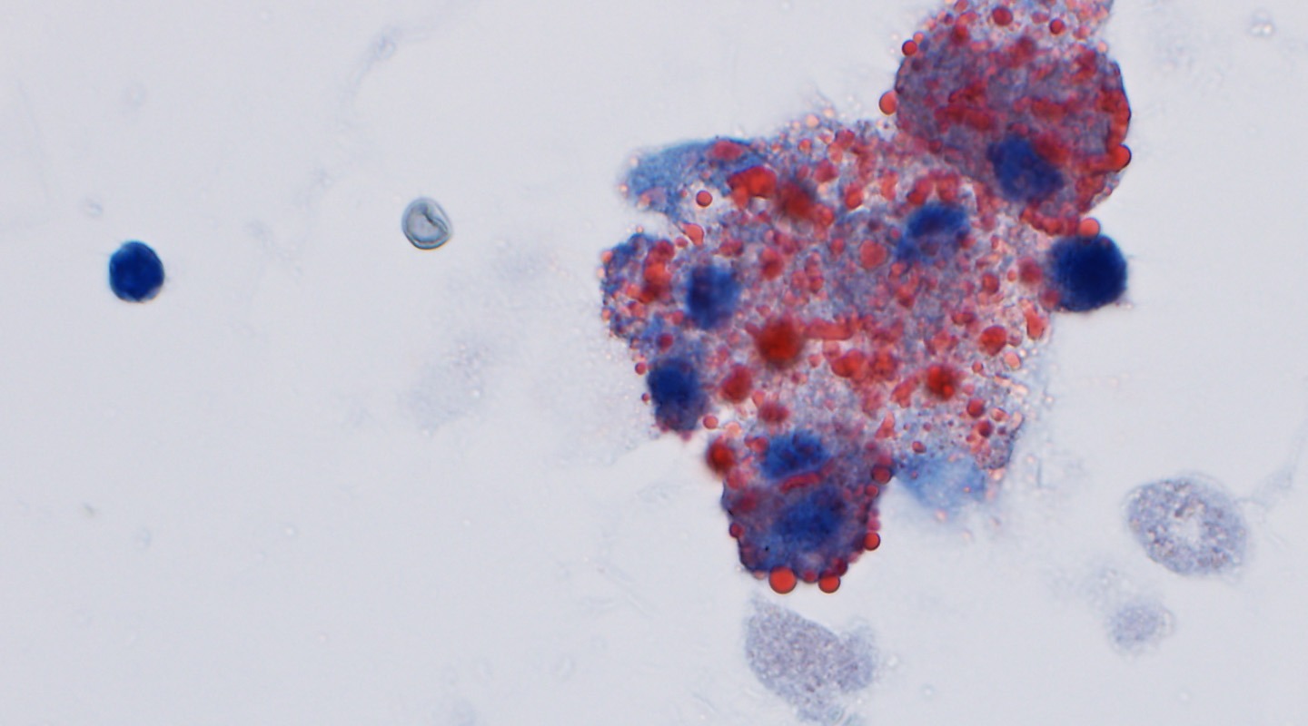 Cytology Standards Minimize Ambiguity in Challenging Specimens